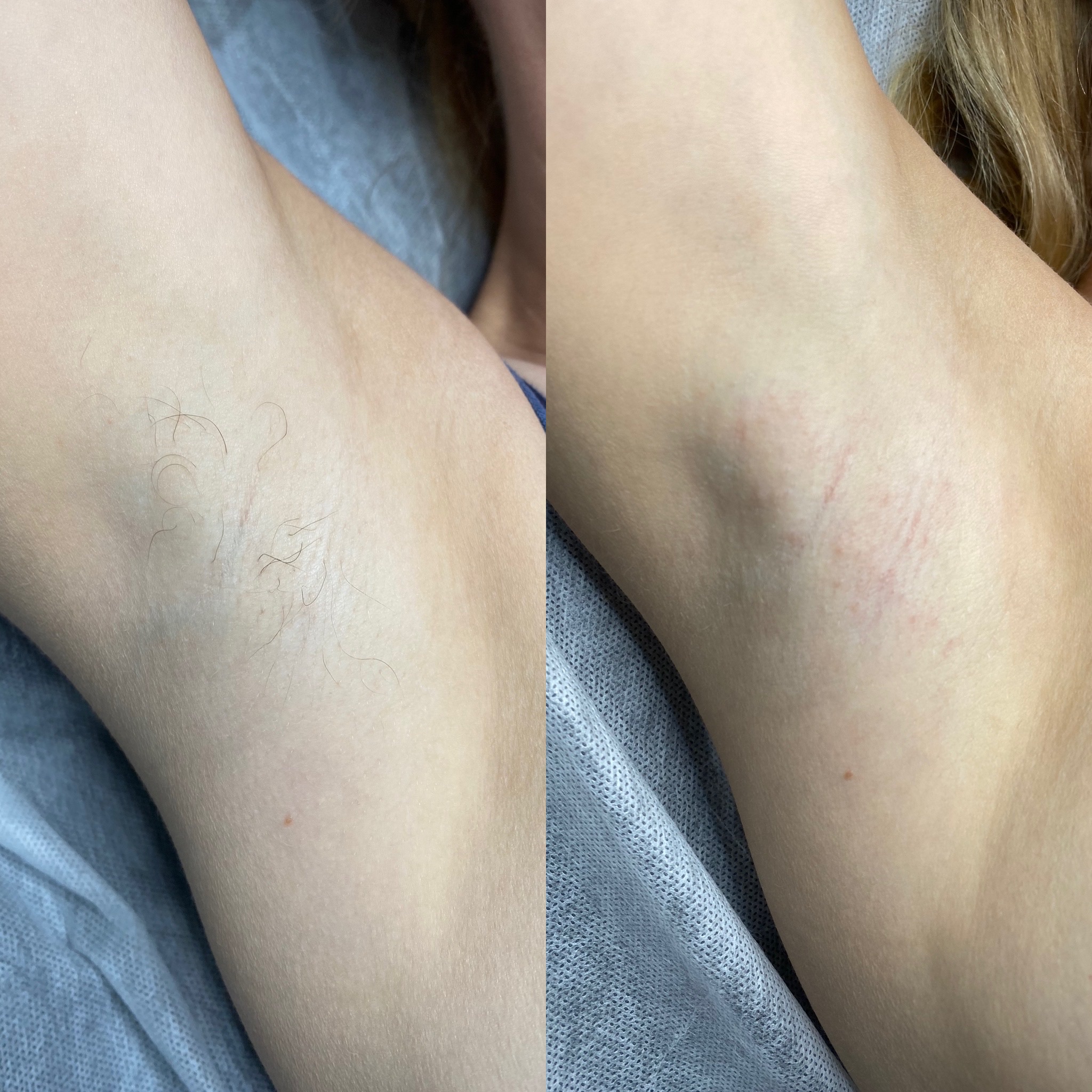 Underarm — in progress