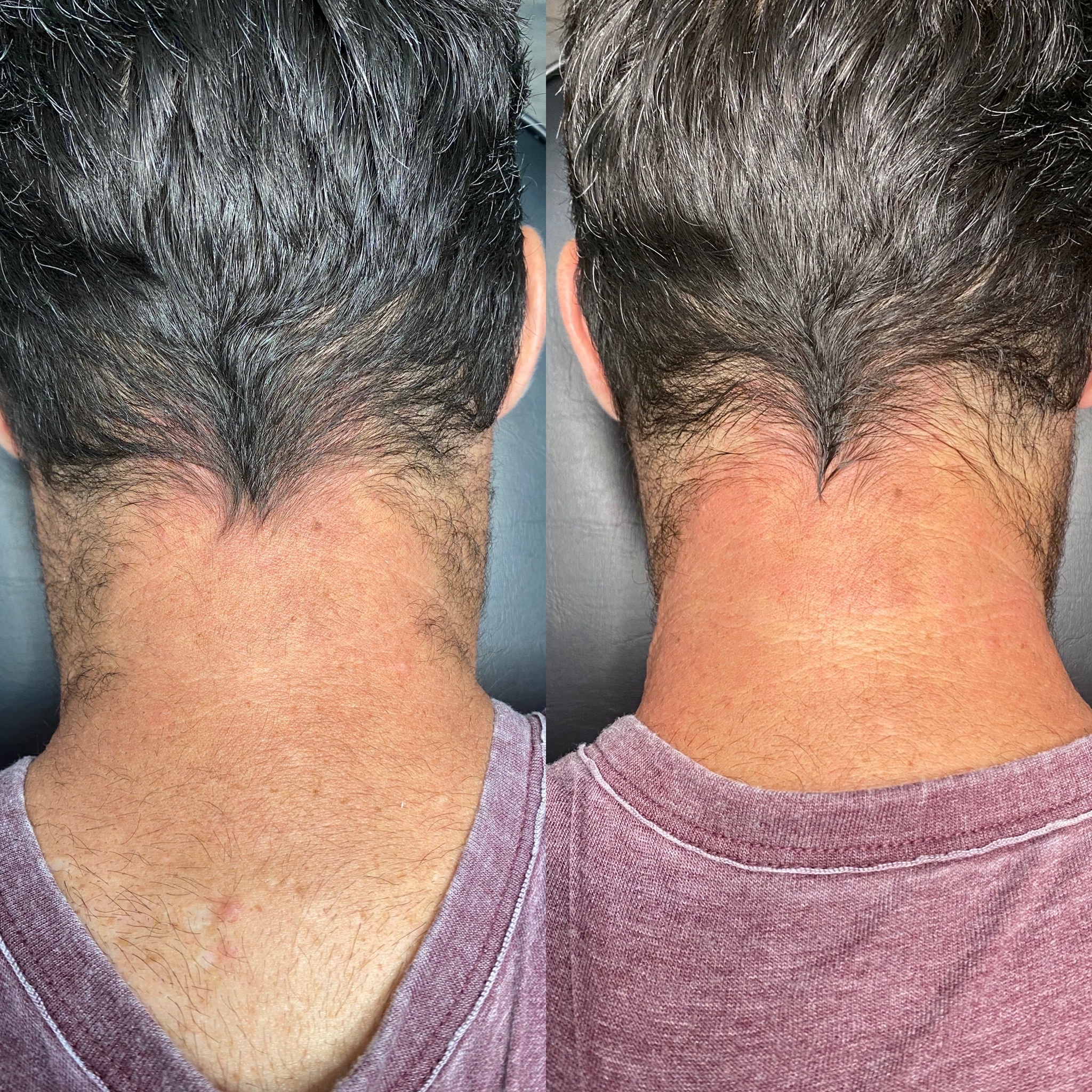 Nape & hairline